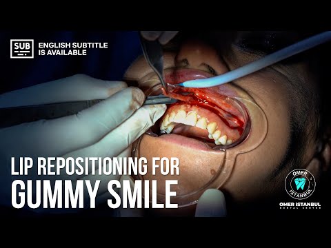 Lip Repositioning Surgery For Gummy Smile - Narrated By Dr. Omer Karaaslan