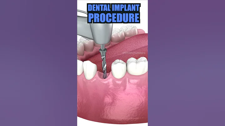 Tooth Implant Process - DayDayNews