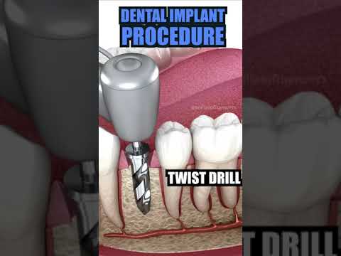 Pain-Free Dental Implant Procedure Condit OH