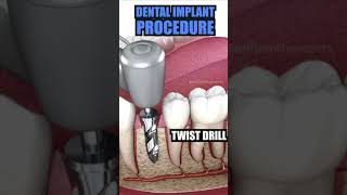 Tooth Implant Process