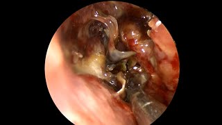 MUCORMYCOSIS Post - Op Sino-Nasal Washes & Routine Endoscopy to check for RE-Infection of Fungus