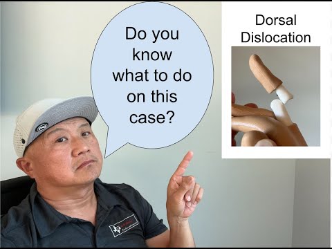 Dorsal finger dislocation | #sportsmedicinespecialist #athletictraining #fingerdislocation