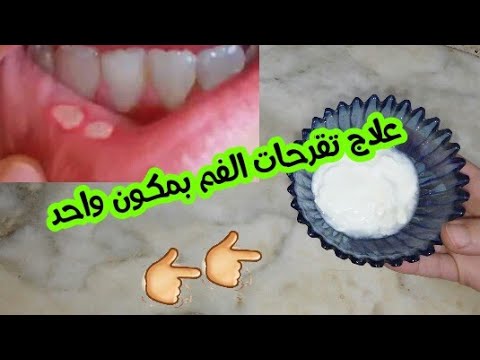 علاج تقرحات الفم و اللسان طبيعيا عند الأطفال و الكبار ✔ مجربة 100%