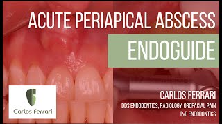 Acute Periapical Abscess and Endoguide