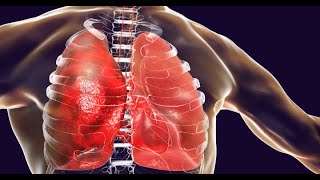 Fast Facts About Pneumonia Webmd