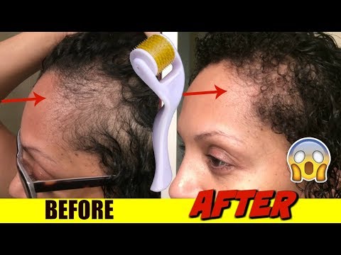 What 192 Microneedle Skin Care Roller Review