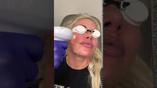 IPL Photo Facial Orange County | Dr Roham