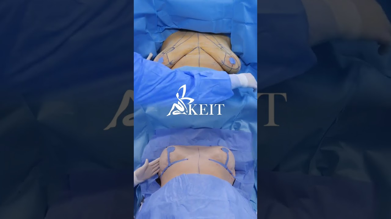 Saggy breasts are not a problem anymore if you choose Breast Remodeling at KEIT Day Hospital