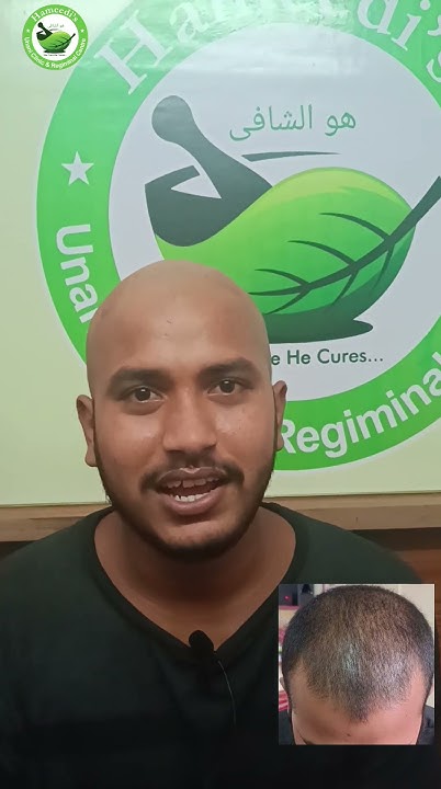 hair-fall-treatment-with-unani-medicine-cupping-youtube