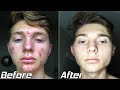 How I Cleared My Acne | Acne Transformation Story (2020)