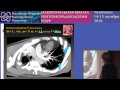 О.Н. Чернова - Использование рентгеноконтрастных средств высокой концентрации в диагностике ТЭЛА