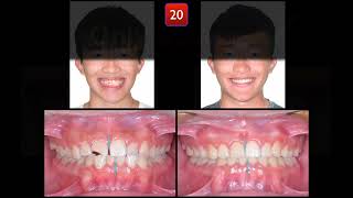 Solving Class III with Anterior Crossbite & Midline Deviation｜【Chris Chang Ortho】CC661