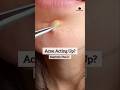 Acne acting up? Try this | Simple home remedy