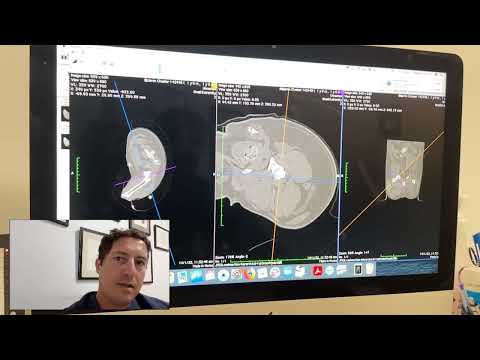 Another avascular necrosis case! Dr. James highlights some interesting aspects of this case.