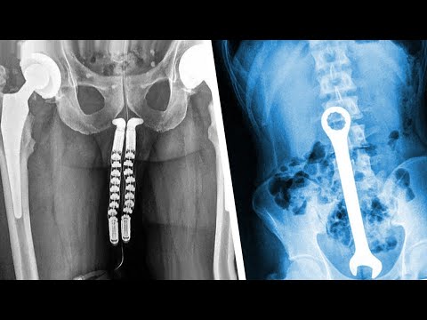 5 უცნაური რამ, რაც რენტგენის აპარატით დააფიქსირეს
