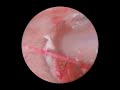 S02E22 - Earwax Removal Agonizing Painful Impacted Orange &amp; Solid As A Stone Ear Wax Cleaning