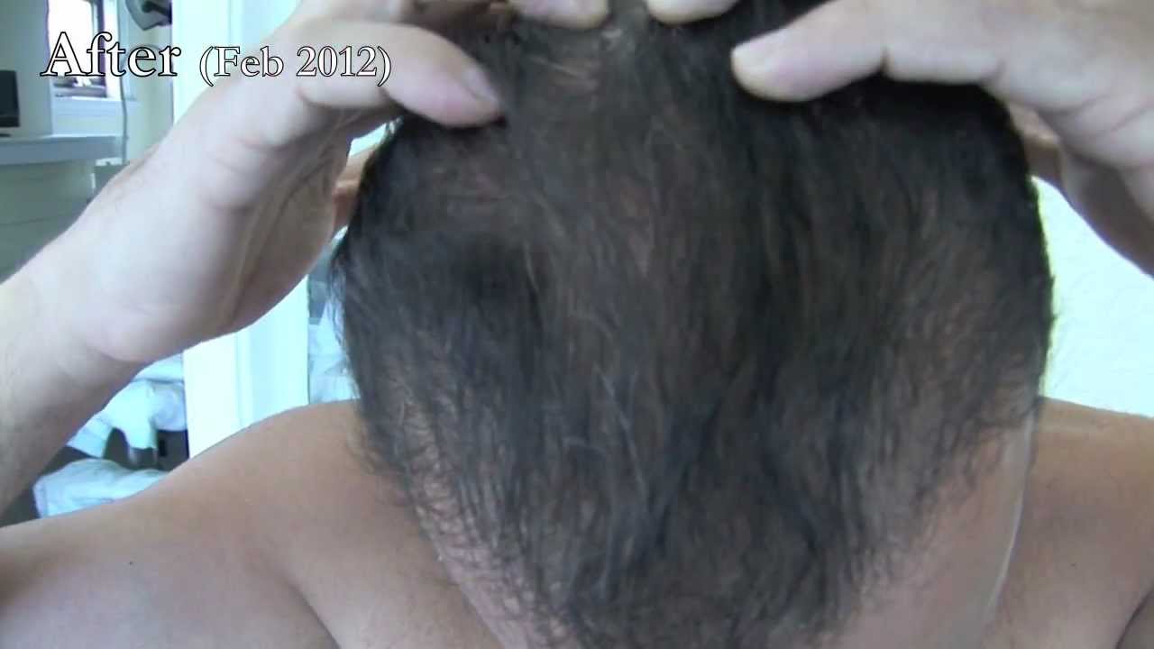 FUE Hair Transplant By Dr Woods in Sydney For Hair Loss & Treatment