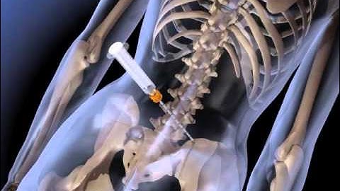 Arrow® OnControl® Bone Marrow Aspiration & Biopsy Patient Video -MC 001173