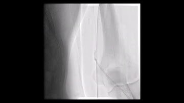 How to progress from radial artery spasm?  Balloon assisted tracking technique.