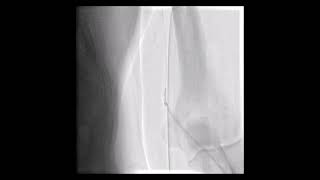How to progress from radial artery spasm?  Balloon assisted tracking technique.