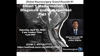 Chiari 1 Malformation: Diagnosis and Management Part 1