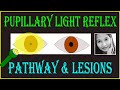 Pupillary light reflex  pathway  lesions  neuro ophthalmology