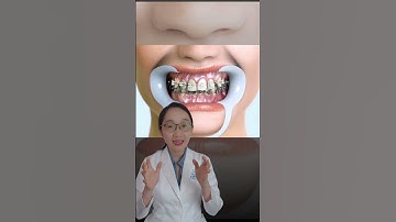 Quá trình niềng răng như thế nào? #shorts