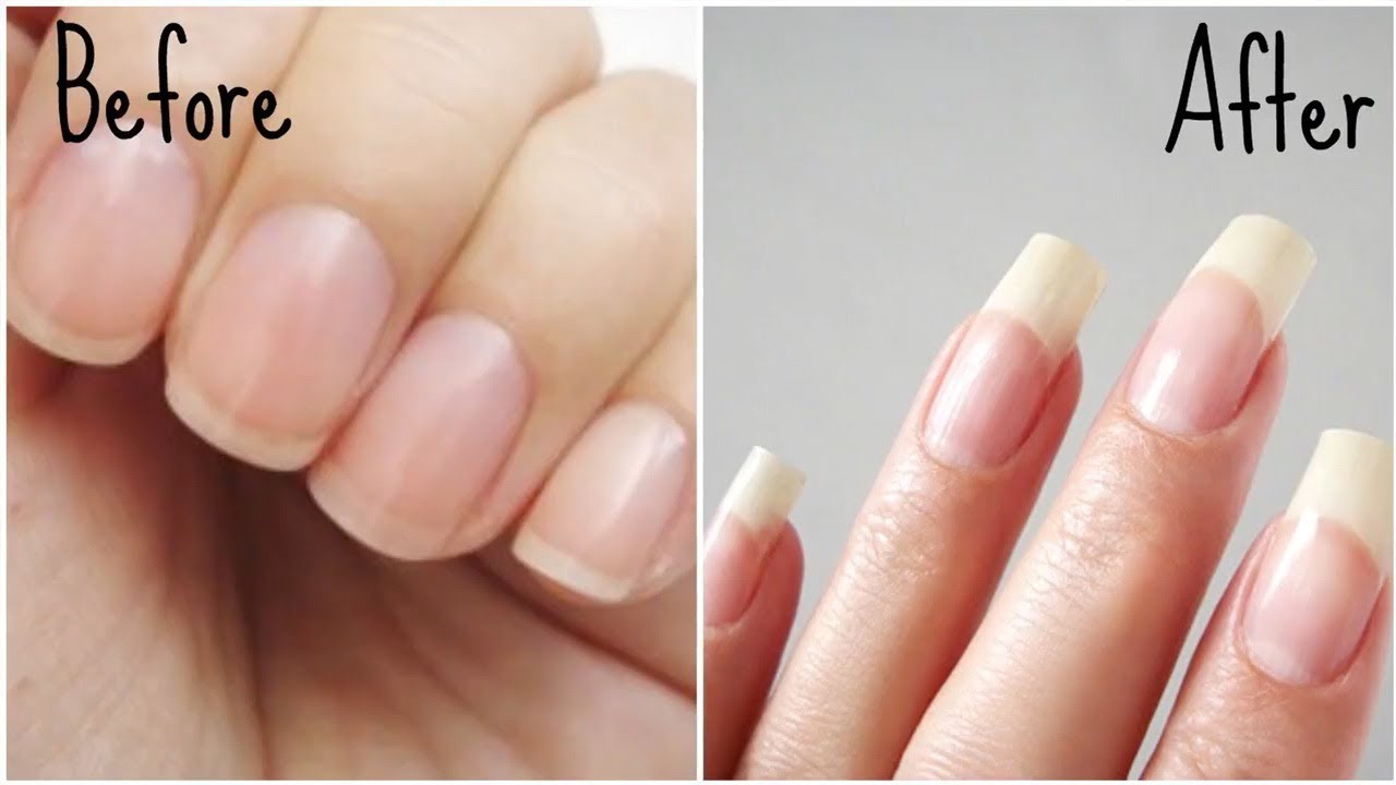 Black lines on nails- do you need to worry??? - MBBS MD (MAMC) (SKIN)-  HINDI 2020 | Kya aapne apne nakhuno ko dhyaan se dekha hai? Kahi aapne uspe  koi kaali line