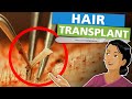 Hair transplant