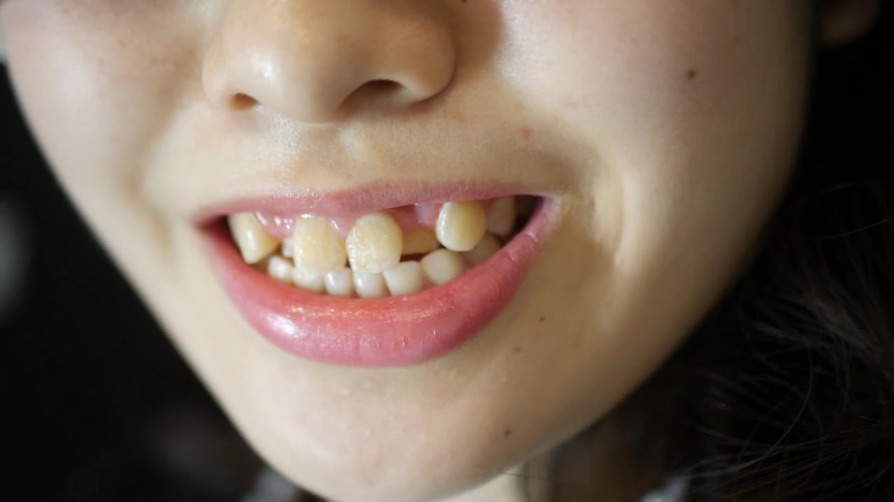 八重歯 に する 方法