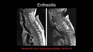 Lumbar Inflammation Pt  3
