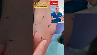 multiple lipoma #cystremoval #pimplepopper #lipomaremoval #drkhaledsadek #shorts