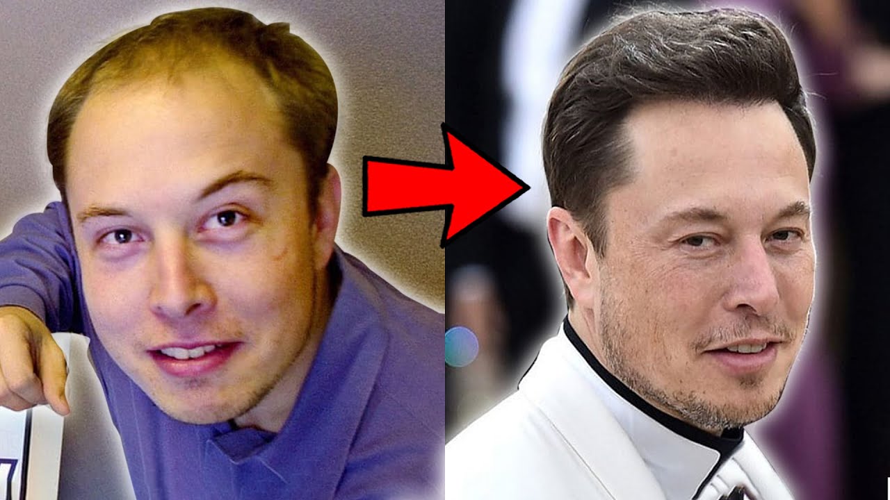 How Elon Musk Reversed His Hair Loss - thptnganamst.edu.vn