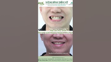 Trước và sau niềng răng khấp khểnh tại Nha khoa AVA  #niengrang #niềngrăngtrongsuốt #niengrangmom