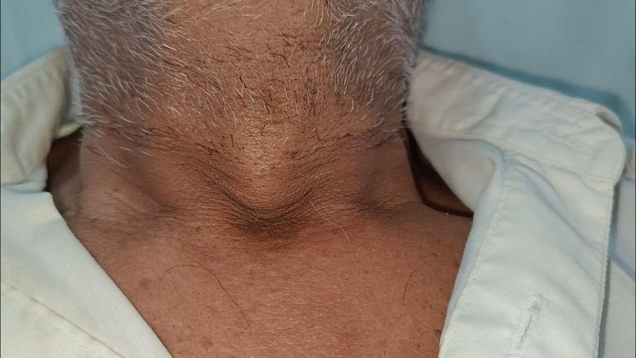 Tracheal tug in copd chronic obstructive lung disease youtube
