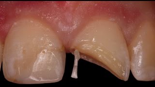 Rebuilding a Fractured Tooth with Pins