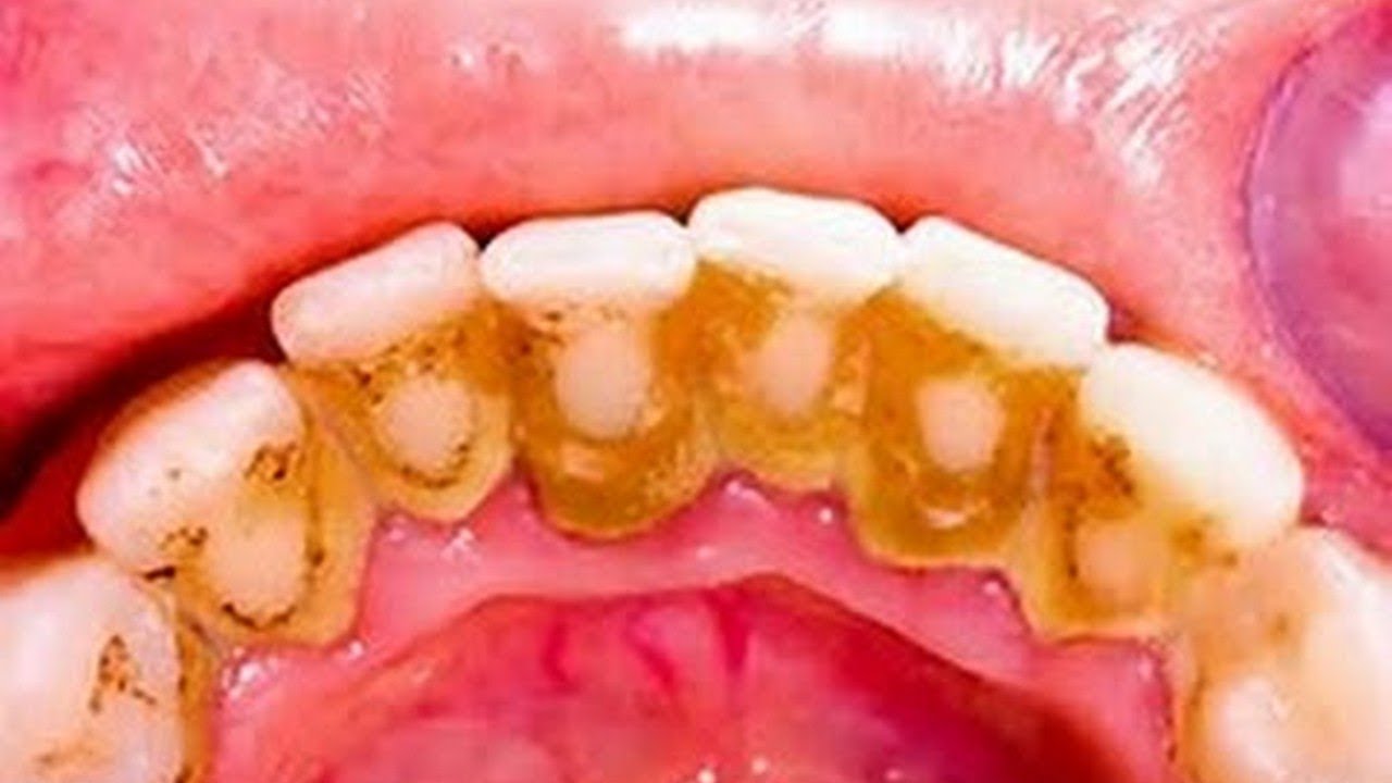 HOW TO REMOVE PLAQUE WITHOUT GOING TO THE DENTIST YouTube