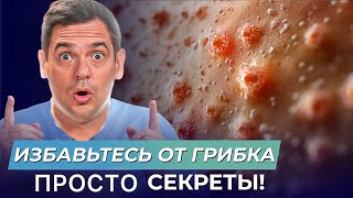 Как НАВСЕГДА избавиться от грибка в 2025 году?
