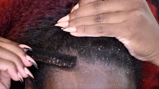 ITCHY DRY SCALP | SCRATCHING DANDRUFF | RAKING SCALP