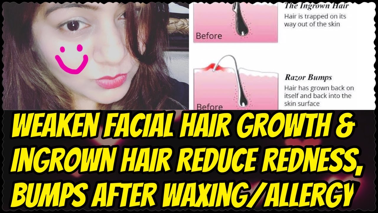 Home Remedy For Ingrown Hair Pimples Redness After Waxing