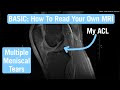 How to Read a MRI in MyChart (Knee Meniscus Tear) | BASIC Explanation by MD Student w/ Chapters