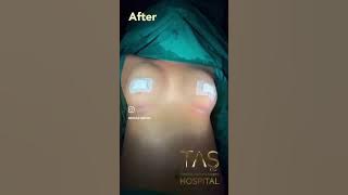 Breast aesthetics #bestplasticsurgeon