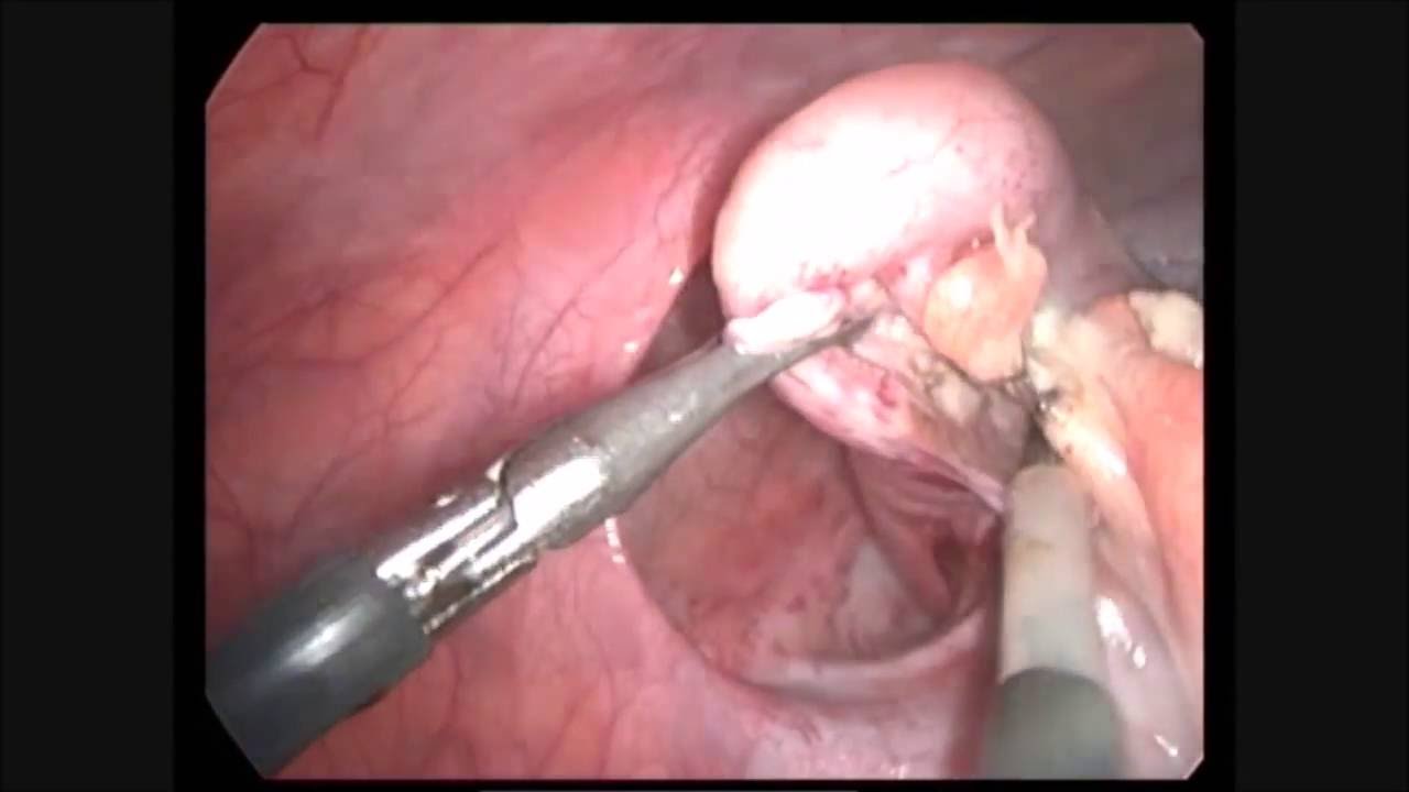 Laparoscopic Appendectomy Pediatric Surgery YouTube