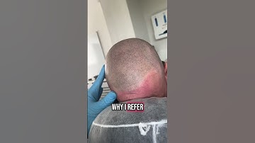 What happens on a second session of #scalpmicropigmentation 👀 #smp