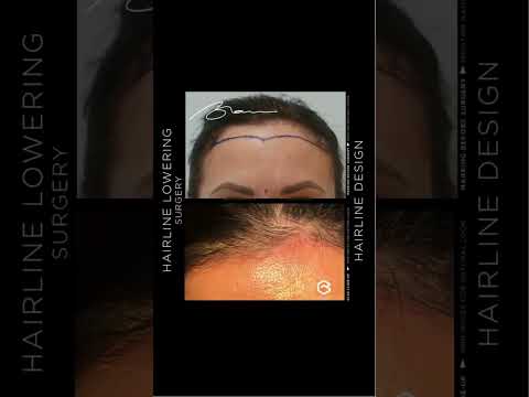 #hairlinelowering Surgery -
