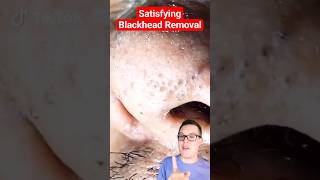 Crazy BLACKHEAD REMOVAL - Blackhead Extraction #shorts