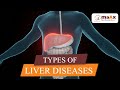 Types of liver diseases  cirrhosis  liver failure  maax hospital