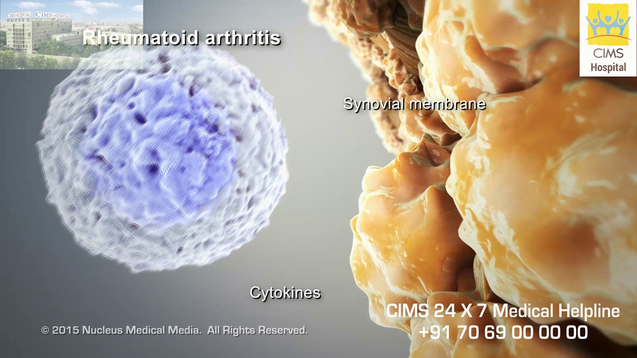 Rheumatoid Arthritis (Gujarati) CIMS Hospital YouTube