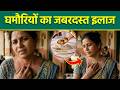 Ghamoriya Dur Karne Ka Upay: घमौरी कैसे ठीक करें,घरेलू इलाज,दवा क्या है | Best Powder & Cream