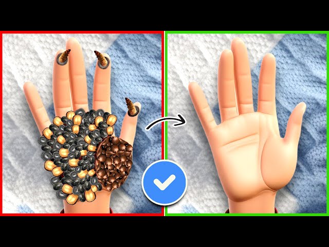 ASMR Remove Dog Ticks & Maggots From Hand | Severely Injured Treatment Animation class=